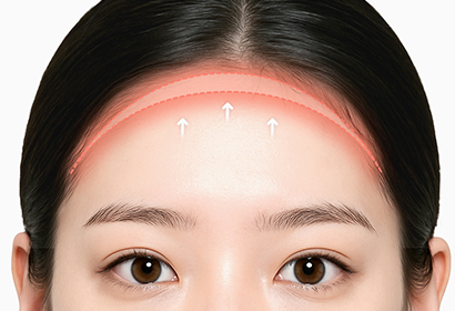 새김 이마축소 수술 방법 02