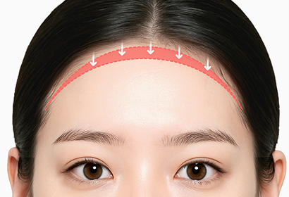 새김 이마축소 수술 방법 03