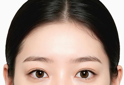 새김 이마축소 수술 방법 04