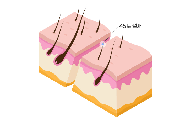 모근 손상을 줄이기 위해 45도 각도로 절개