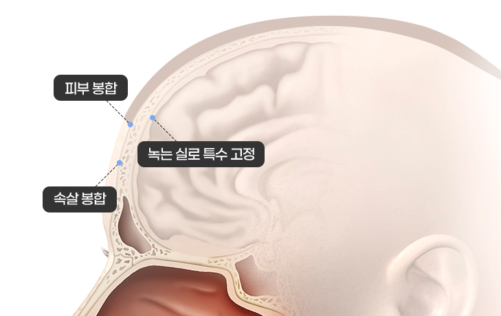 풀림 방지를 위한 삼중 묶음 고정