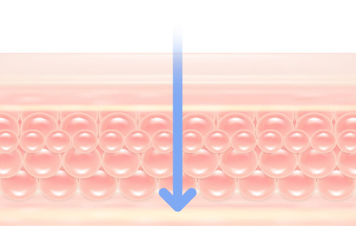 인텐스 울테라 주파수 1MHz