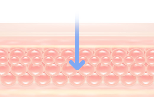 인텐스 울테라 주파수 3MHz