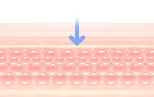 인텐스 울테라 주파수 10MHz