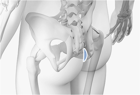 코성형 재료 - 자가진피
