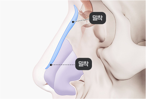 코성형 재료 - 3D 맞춤보형물(핏미코)