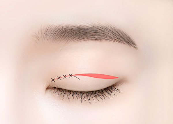 눈매교정 -절개 눈매교정 수술방법 03