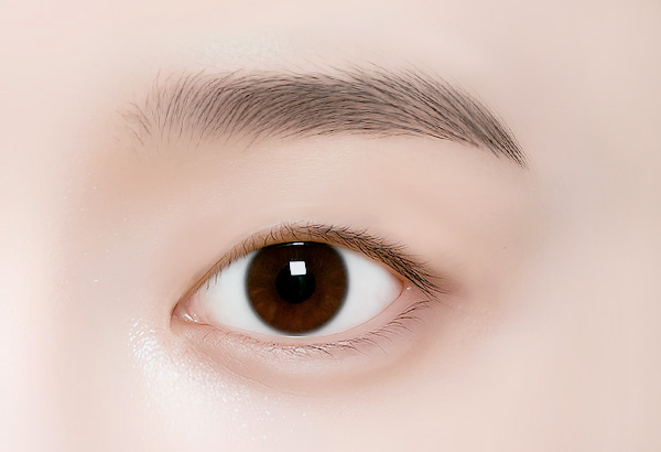 눈매교정 -비절개 눈매교정 수술방법 01