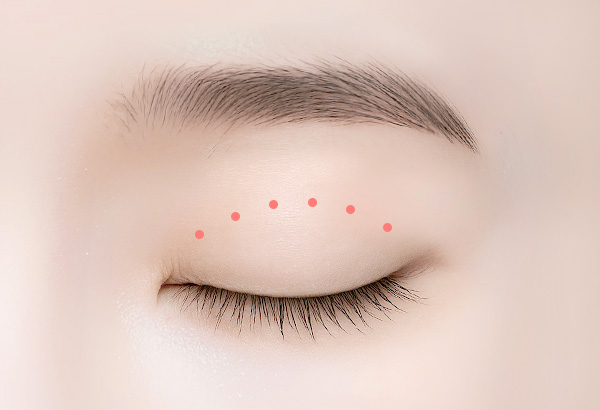 눈매교정 -비절개 눈매교정 수술방법 02