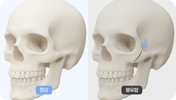 윤곽 재수술 케이스 - 광대 - 불유합이 발생한 경우