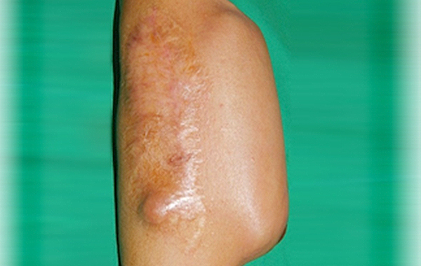 조직 확장기를 이용한 흉터 성형술 step 02