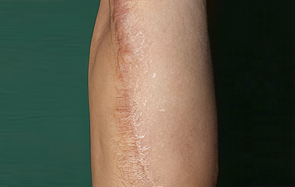 조직 확장기를 이용한 흉터 성형술 step 03