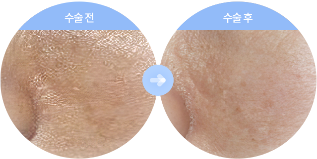 피부 이식술 및 복합조직 이식
