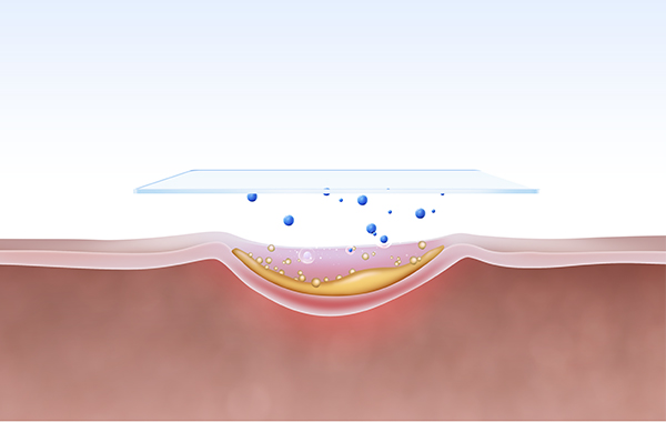 실리콘 젤 시트 요법