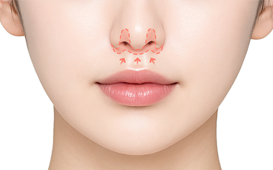 스마스인중축소 수술방법 - 봉합