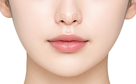 스마스인중축소 수술방법 - 절제부위