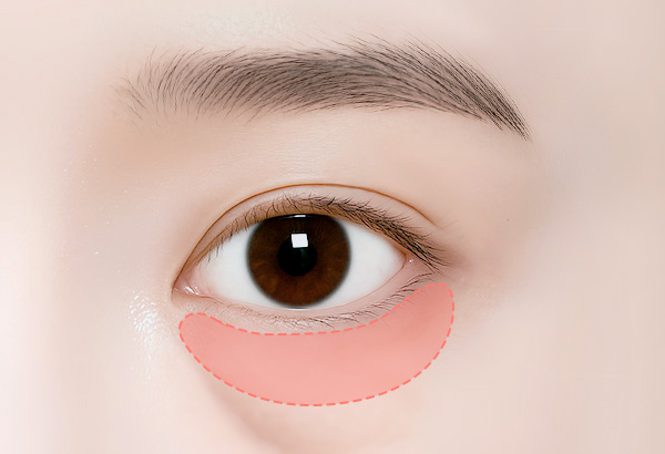 눈밑지방재배치 수술방법 01