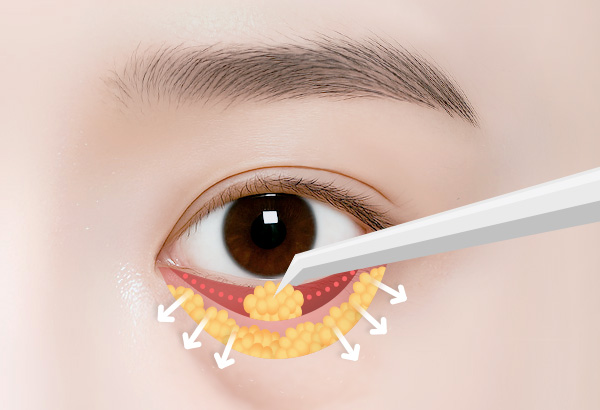 눈밑지방재배치 수술방법 02