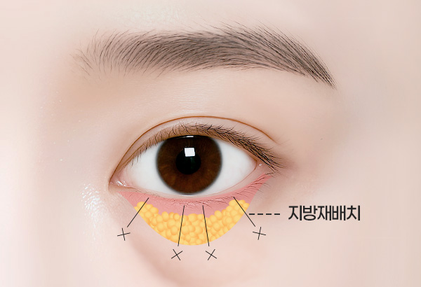 눈밑지방재배치 수술방법 03