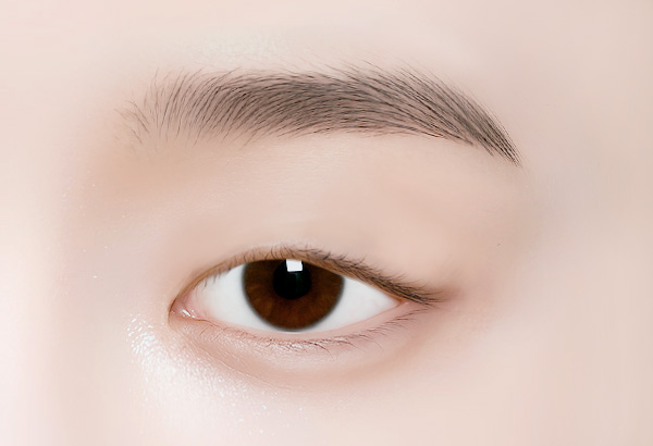 상안검 수술방법 01