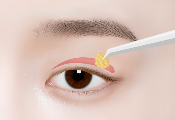 상안검 수술방법 03