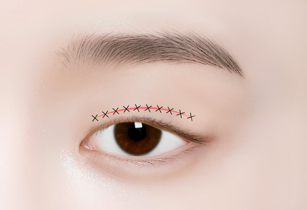 상안검 수술방법 04