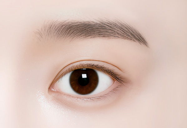 상안검 수술방법 05