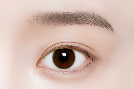 눈매교정을 함께 진행한 경우