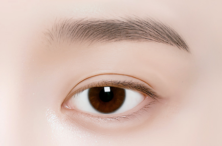 쌍꺼풀 수술만 진행한 경우