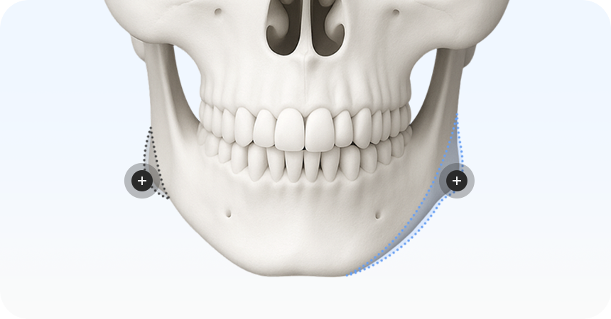 새김 사각턱 축소술의 특별함