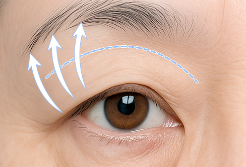 함께하면 더 좋은 수술 - 눈썹거상