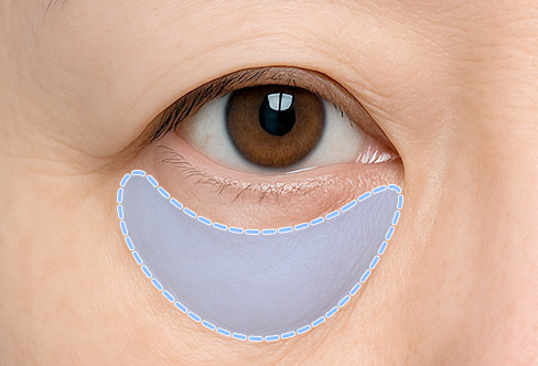 함께하면 더 좋은 수술 - 하안검