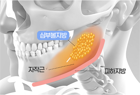 함께하면 더 좋은 수술 - 심부볼제거2