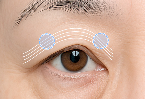 함께하면 더 좋은 수술 - 상안검